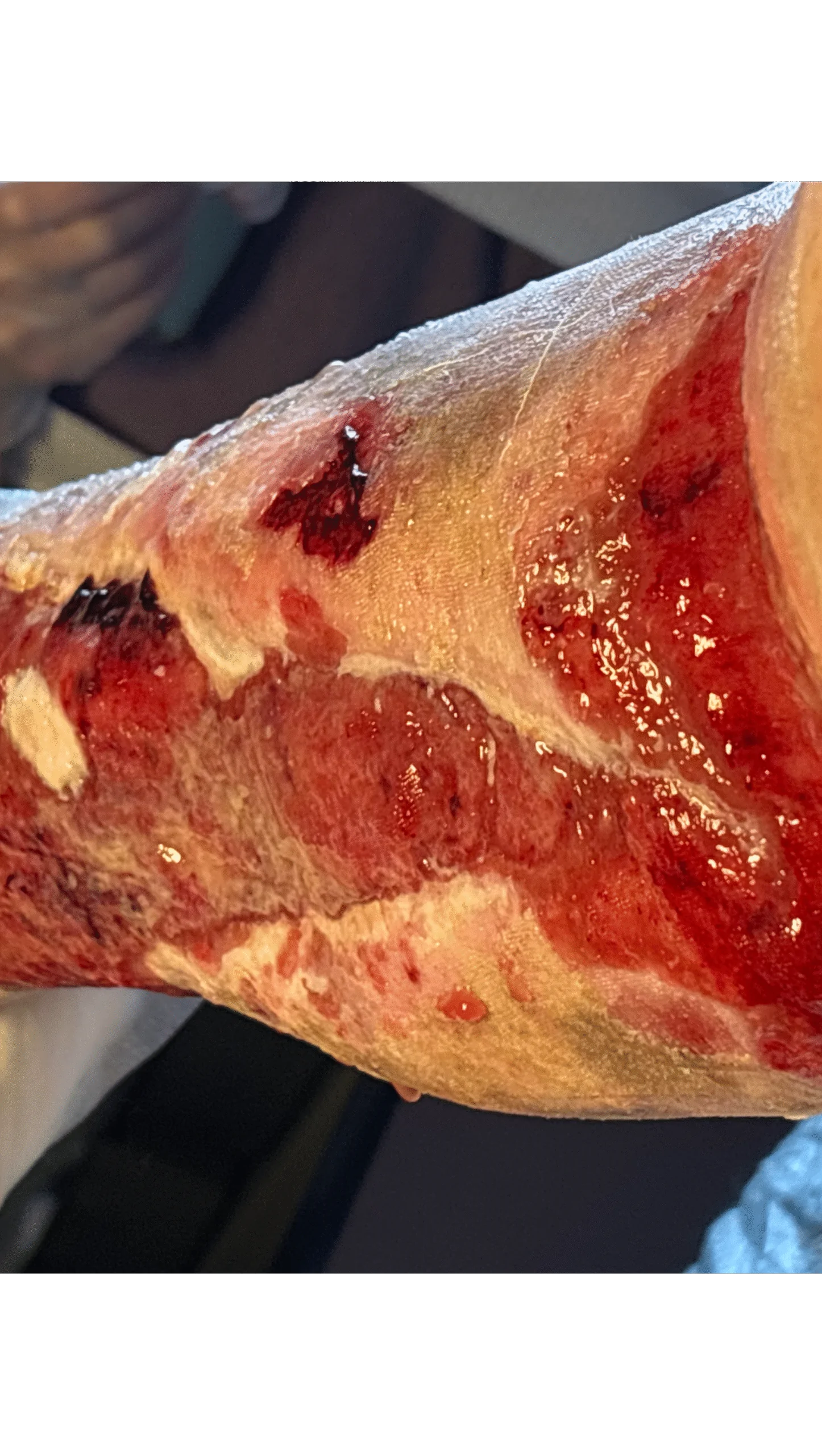 20 years of pain need help get me someone in and out of bed – Fundraiser Donation Help