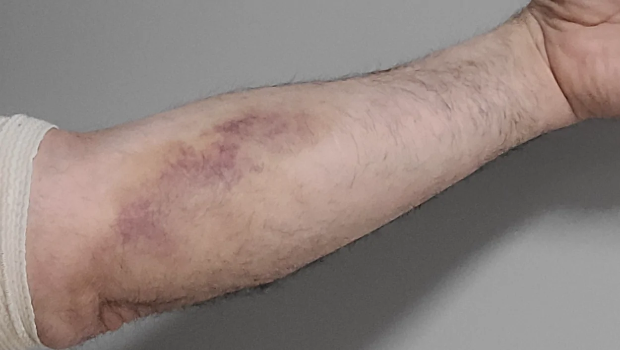 Help Support Steve’s Urgent Surgery Costs for his arm. – GoFundMe Fundraiser gofundme Donation Help